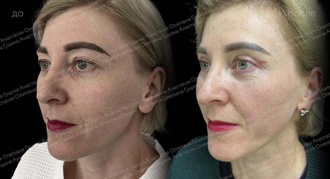 Верхняя блефаропластика