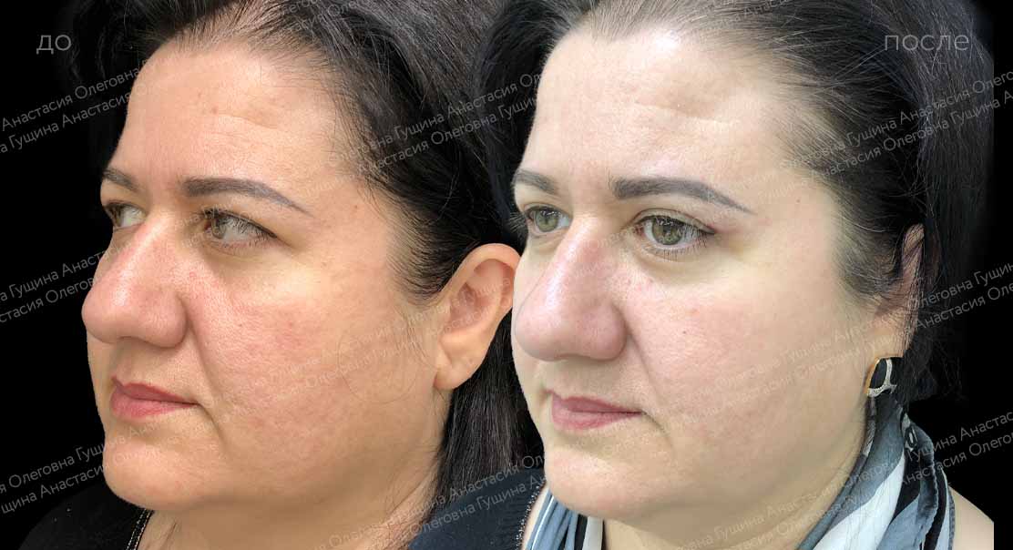 Верхняя блефаропластика