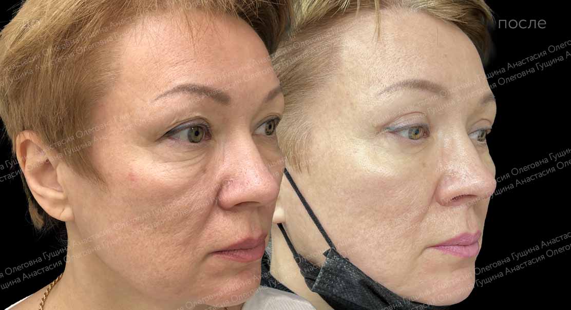 Круговая блефаропластика