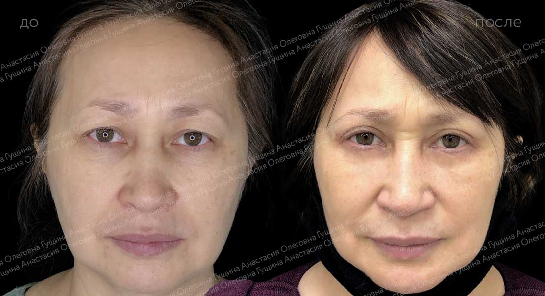 Круговая блефаропластика